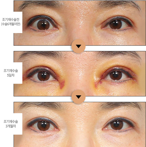 첫 수술 후 4개월 차 > 조기재교정 1주차 > 조기재교정 한달차